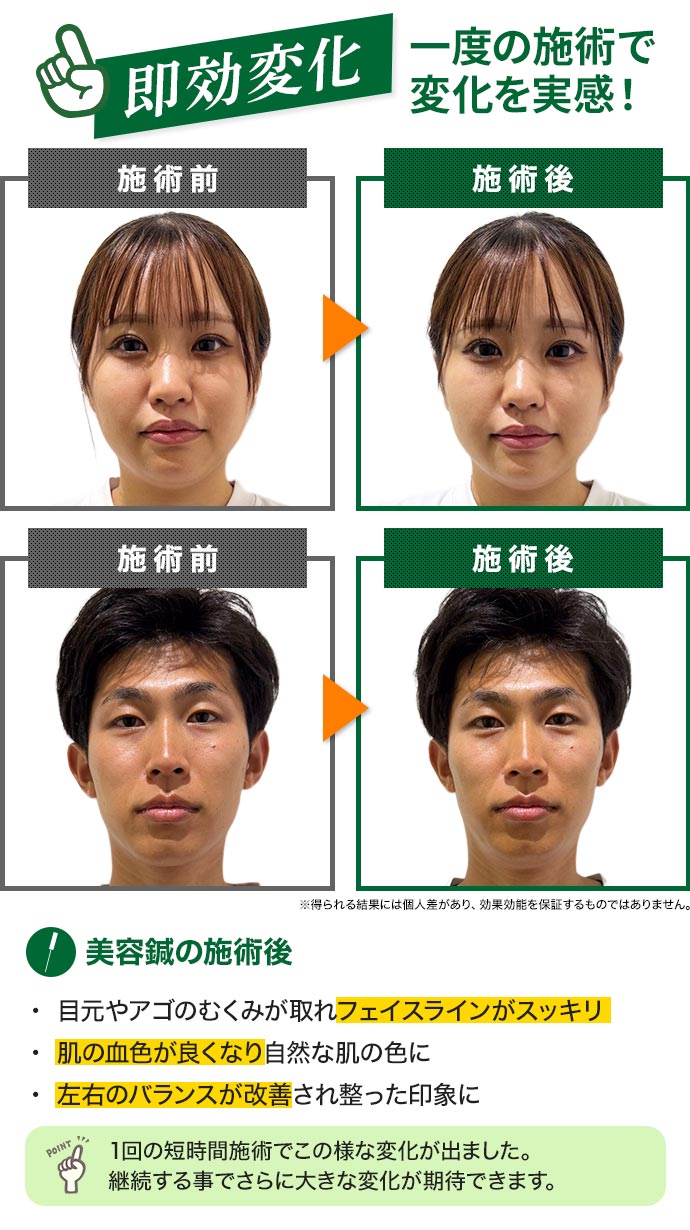 アンチエイジング美容鍼ビフォーアフター