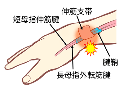 腱鞘炎のイラスト