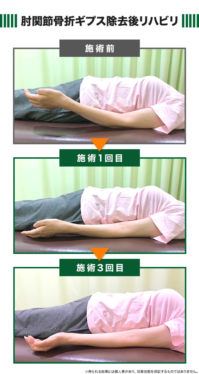 骨折後のリハビリの症例報告