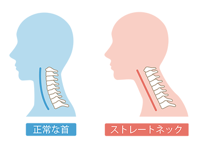 ストレートネックのイラスト